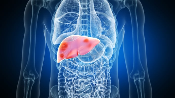 Fatty liver disease to affect 2 billion people by 2050. Fatty liver disease to affect 2 billion people by 2050.