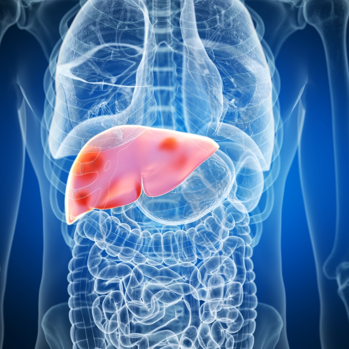 The rising tide of fatty liver disease: Over 2 billion cases expected by 2050