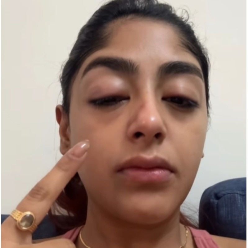 Swollen face, broken tooth: Splitsvilla X6's Preet alleges assault, seeks justice