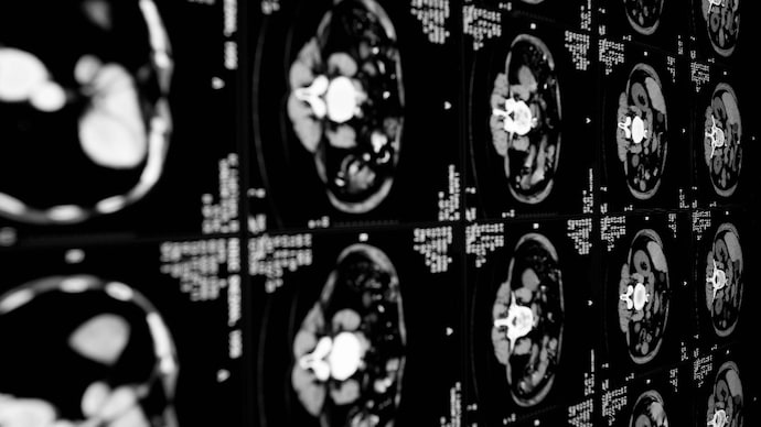 The tool works by analysing routine abdominal CT scans, which are tests that many patients already undergo for other health reasons. (Photo: Getty Images) The tool works by analysing routine abdominal CT scans, which are tests that many patients already undergo for other health reasons.