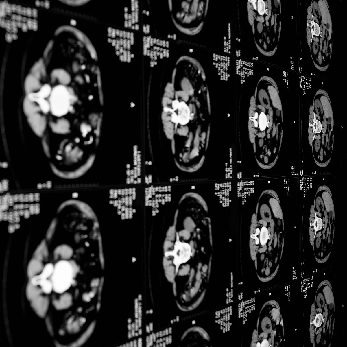 Mayo Clinic AI spots pancreatic cancer up to three years before diagnosis