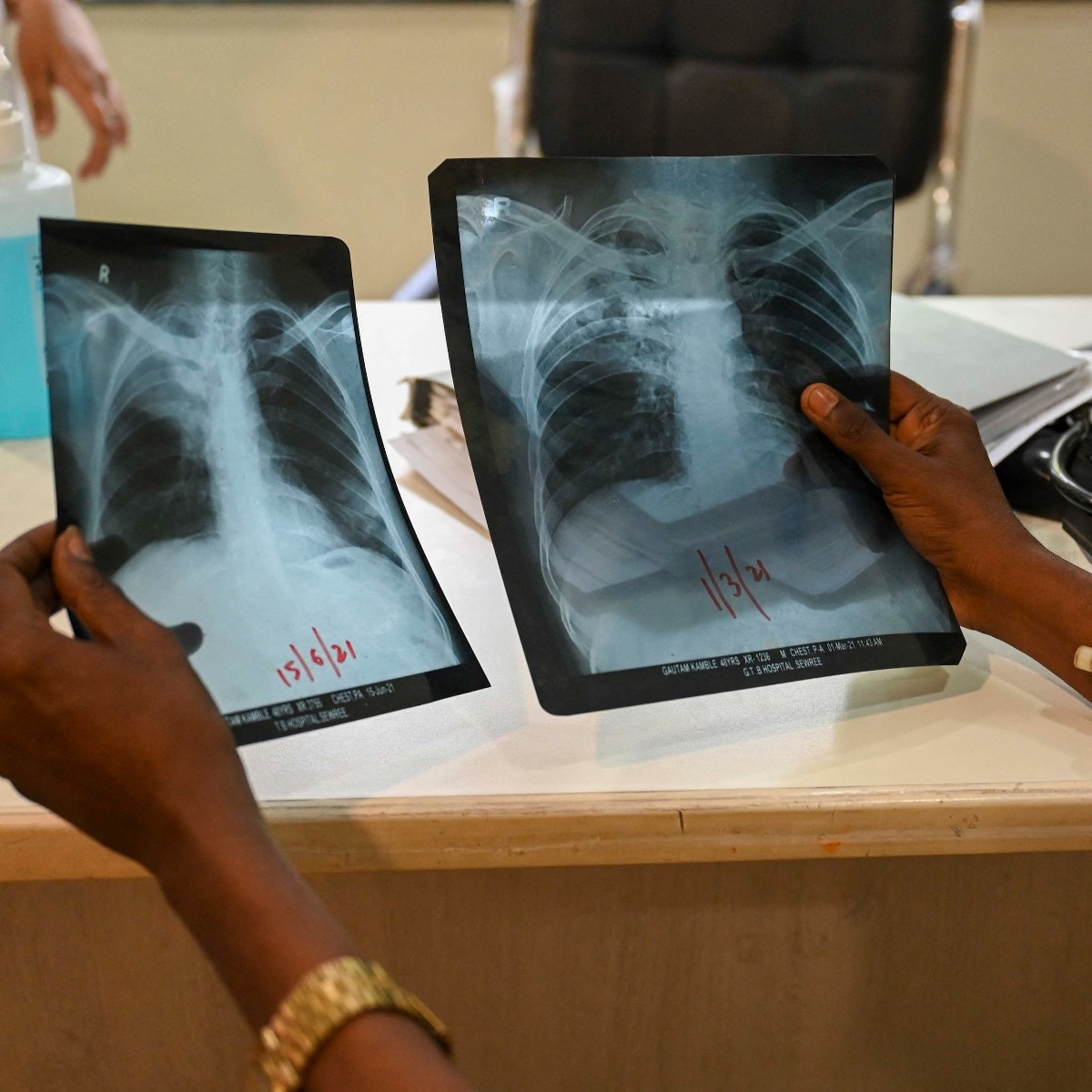 Desperate efforts to stem the pandemic hurt the battle against another huge killer: tuberculosis.