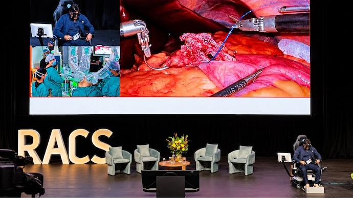 An Indian surgeon performed a robotic gastrojejunostomy on a patient in Indore from a console in Perth, Australia, from a distance of over 10,000 kilometres, using India's indigenous SSI Mantra surgical robotic system. (Photo: Special arrangement) Dr Mohit Bhandari performed a robotic gastrojejunostomy on a patient in Indore from a console in Perth, Australia, from a distance of over 10,000 kilometres, using India's indigenous SSI Mantra surgical robotic system. (Photo: Special arrangement)