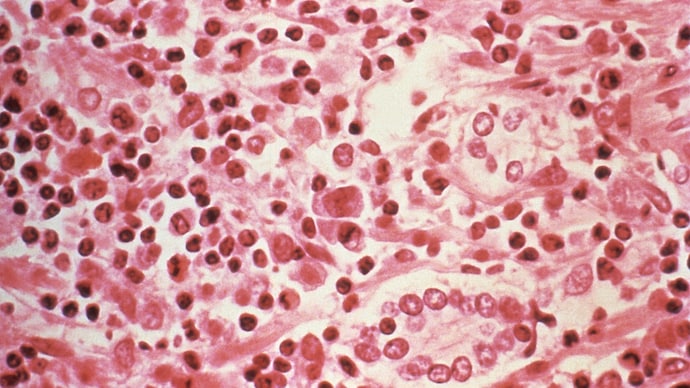 A micrographic study of liver tissue seen from a Hantavirus pulmonary syndrome (HPS) patient seen in this undated photo obtained by Reuters.
