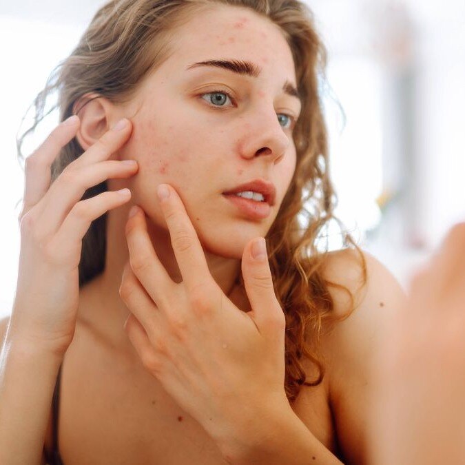 Pimples before periods? Here’s what your body may be trying to tell you