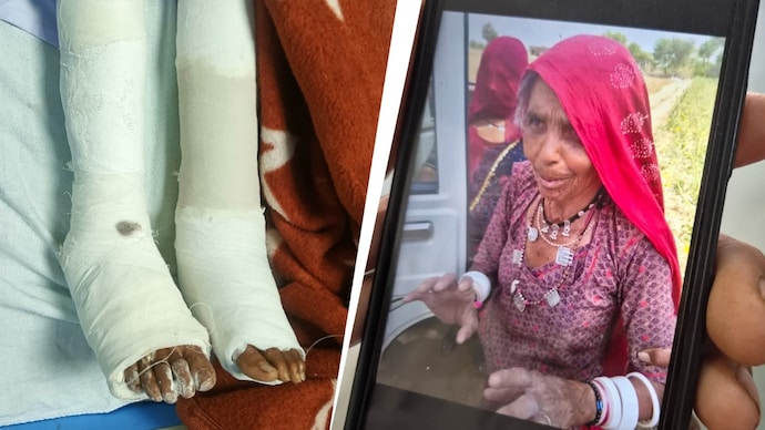 The woman, aged 66, was injured in a fight and both her legs were plastered. Jodhpur case
