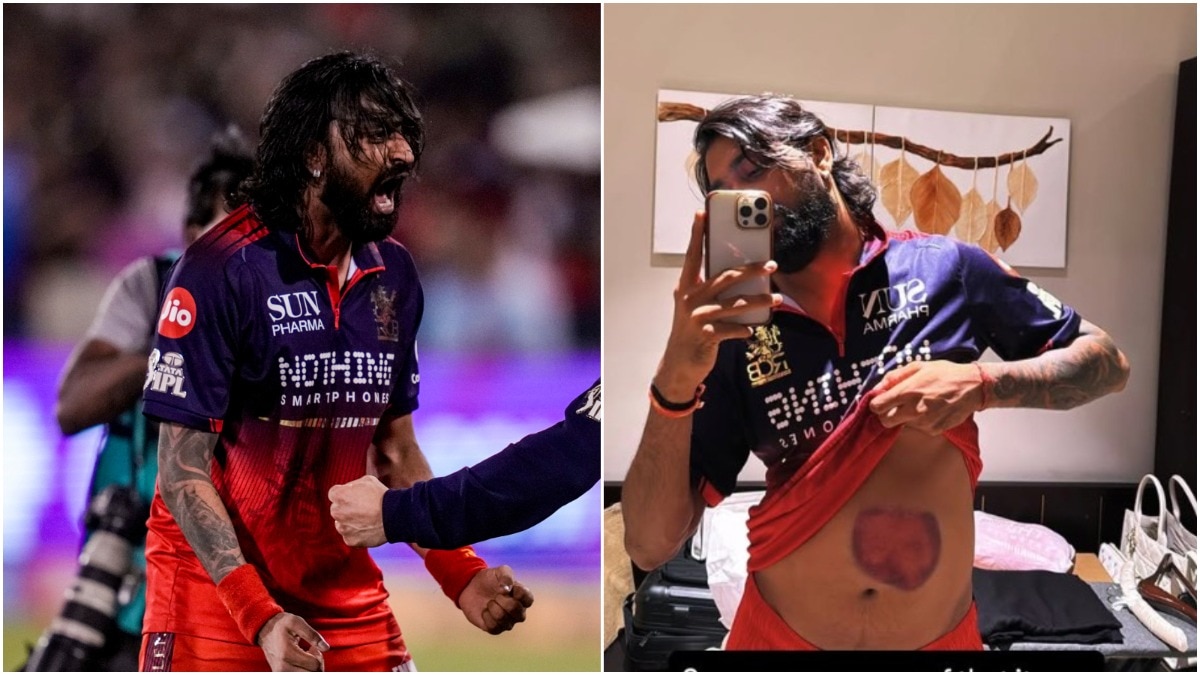 Krunal Pandya shares pic of bruised stomach after heroic knock vs MI in Raipur