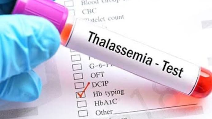 An estimated 1-1.5 lakh kids in India have severe thalassemia Maharashtra will soon introduce rules making thalassemia testing mandatory before marriage