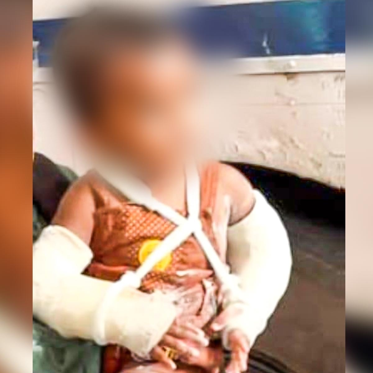 Cigarette burn marks, 51 injuries found on Kerala toddler; stepfather in custody