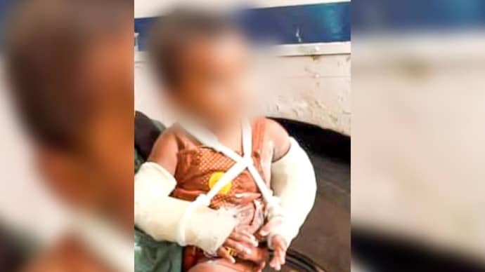 A video made by an influencer showed the little boy with both hands in plaster casts while standing alongside his mother. A video made by an influencer showed the little boy with both hands in plaster casts while standing alongside his mother.