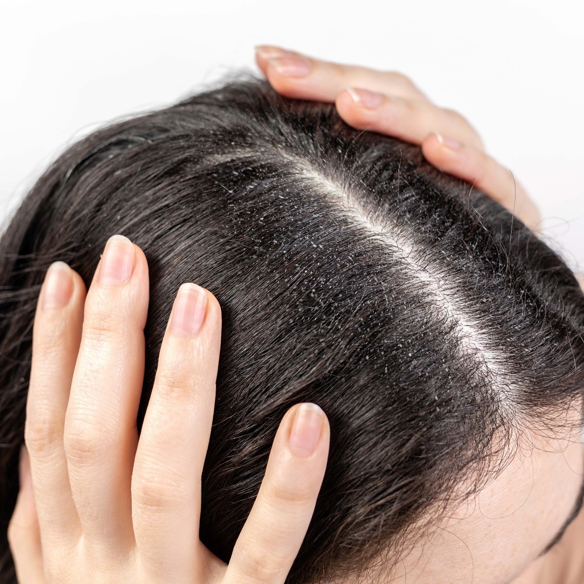 Why your dandruff keeps coming back, and what your scalp may be trying to tell you