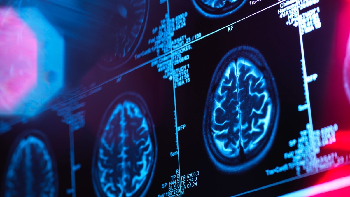 Woman with Alzheimer's sees major improvements after taking 