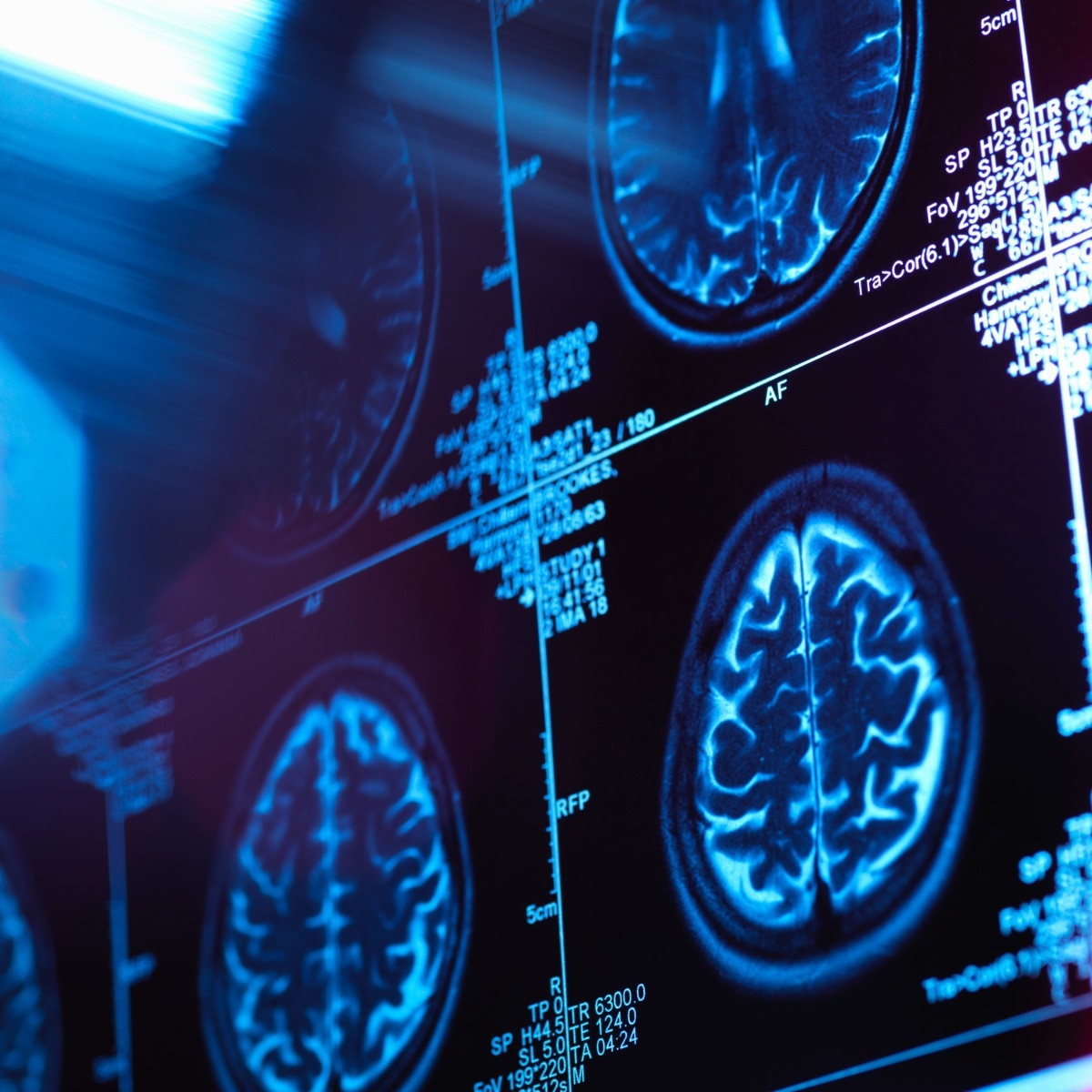Woman with Alzheimer's sees major improvements after taking magic mushrooms