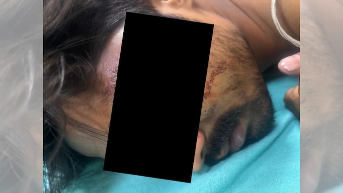 Gurugram lift operator loses eye after rescuing trapped residents. Gurugram lift operator loses eye after rescuing trapped residents.
