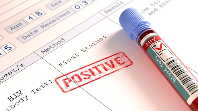 Positive HIV (human immunodeficiency virus) blood test results, computer illustration.