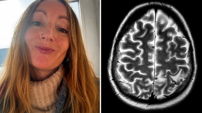 Got 38 parasites in brain from India, says UK woman.