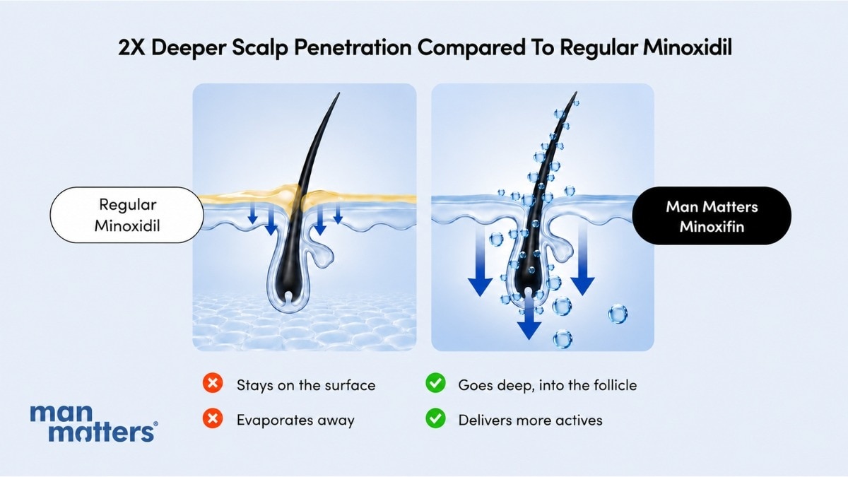 Expert-Backed Advice on How Alcohol- Free Minoxidil Could Be the Best Option for Hair Loss Among Men