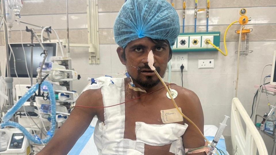 Impaled by 4 iron rods, labourer survives after 8.5-hour surgery in Lucknow