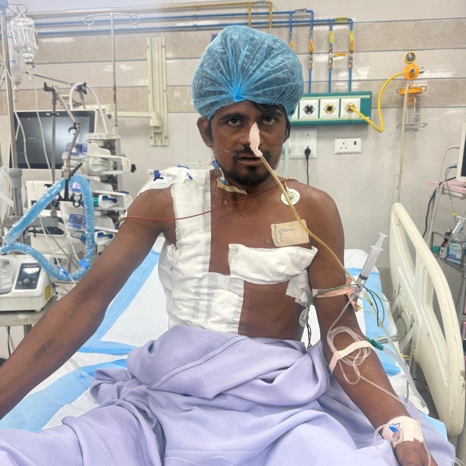 Impaled by 4 iron rods, labourer survives after 8.5-hour surgery in Lucknow