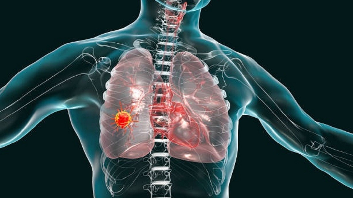Lung cancer becomes India's top cancer killer