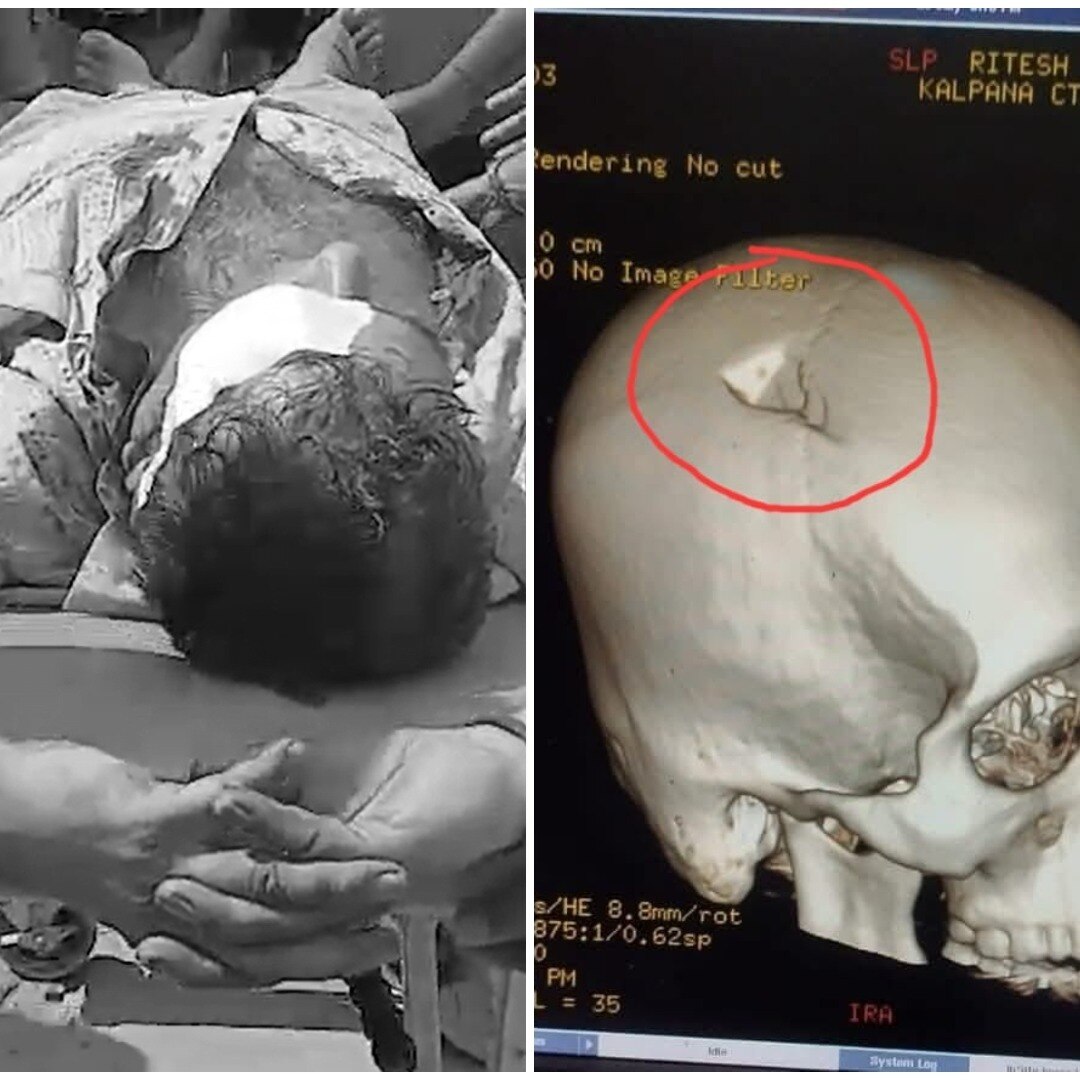 Officer Ritesh Kumar Singh suffered critical head injuries and underwent surgery after being struck by a cast iron weight.