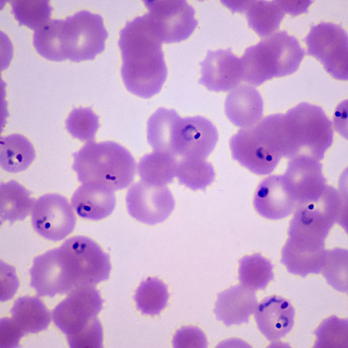 Cyclospora outbreak crosses 2,600 cases: Doctor explains how the parasite spreads