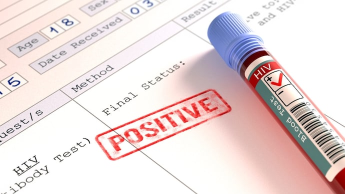 Positive HIV (human immunodeficiency virus) blood test results, computer illustration.
