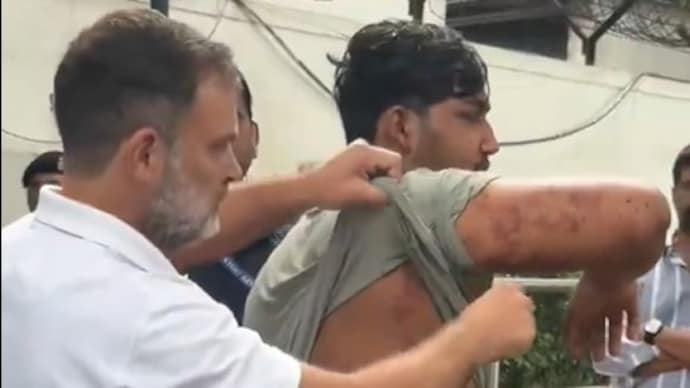 Rahul Gandhi pellet