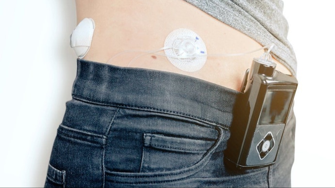This groundbreaking device continually tracks an person's blood glucose levels and automatically adjusts insulin delivery through a pump.