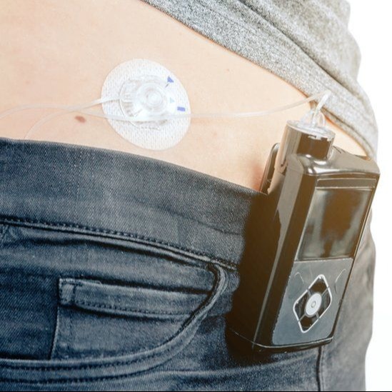 NHS artificial pancreas rollout shows promise, narrows access gap
