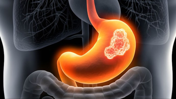 Stomach Cancer