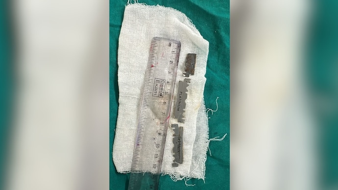 Hyderabad doctors remove 3 razor blade pieces from teen’s stomach in risky procedure Hyderabad doctors remove 3 razor blade pieces from teen’s stomach in risky procedure
