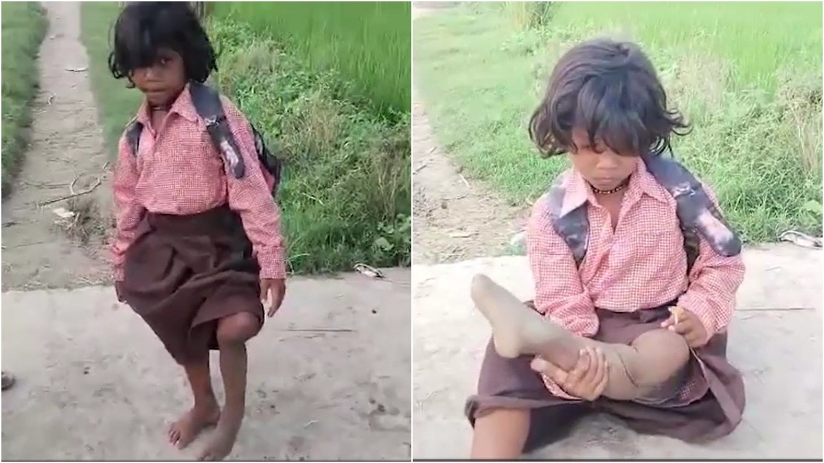 Seven-year-old UP girl who hops 400 metres to school on one leg pleads 'DM uncle, give me a tricycle'; gets two tricycles, aid after viral video