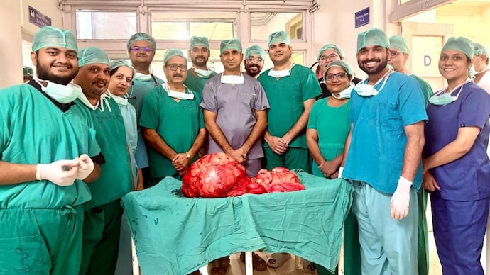 Doctors at SMS Hospital Jaipur successfully remove a 28.6-kg retroperitoneal sarcoma from a 59-year-old woman after a three-hour high-risk surgery. Doctors at SMS Hospital Jaipur successfully remove a 28.6-kg retroperitoneal sarcoma from a 59-year-old woman after a three-hour high-risk surgery.