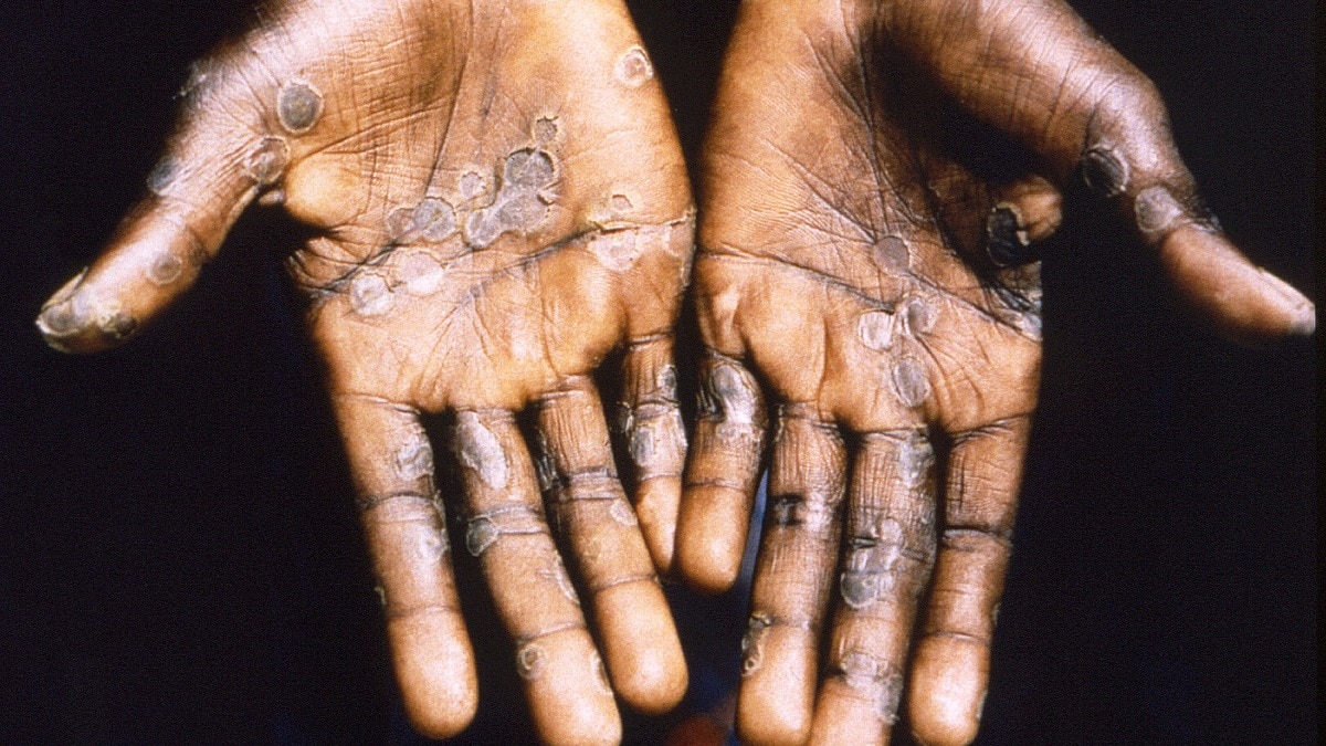Your skin is at high risk. Climate change is the culprit