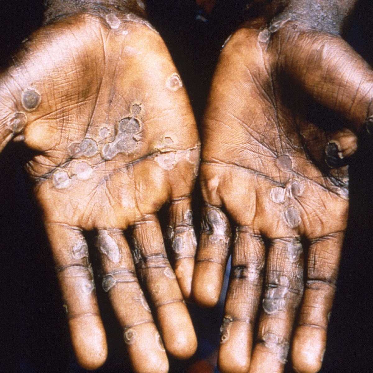 Your skin is at risk of harm. Climate change is the culprit