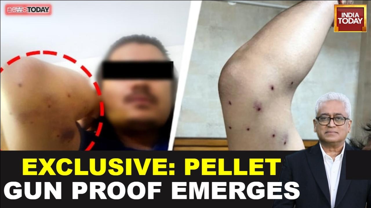 Exclusive: Safdarjung Hospital report confirms pellet gun injuries at NEET protest