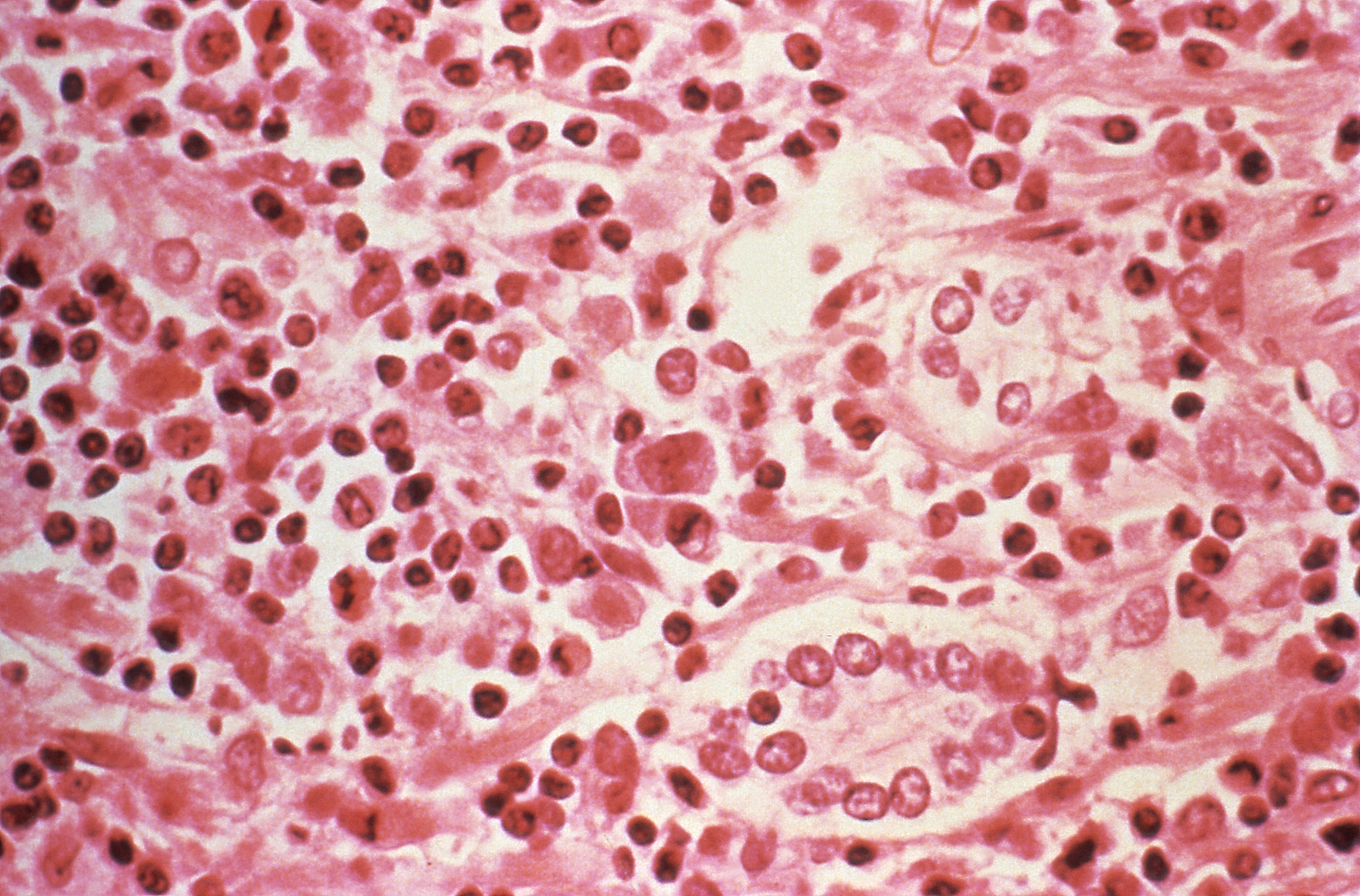 A micrographic study of liver tissue seen from a Hantavirus pulmonary syndrome (HPS) patient. (Photo: Reuters)