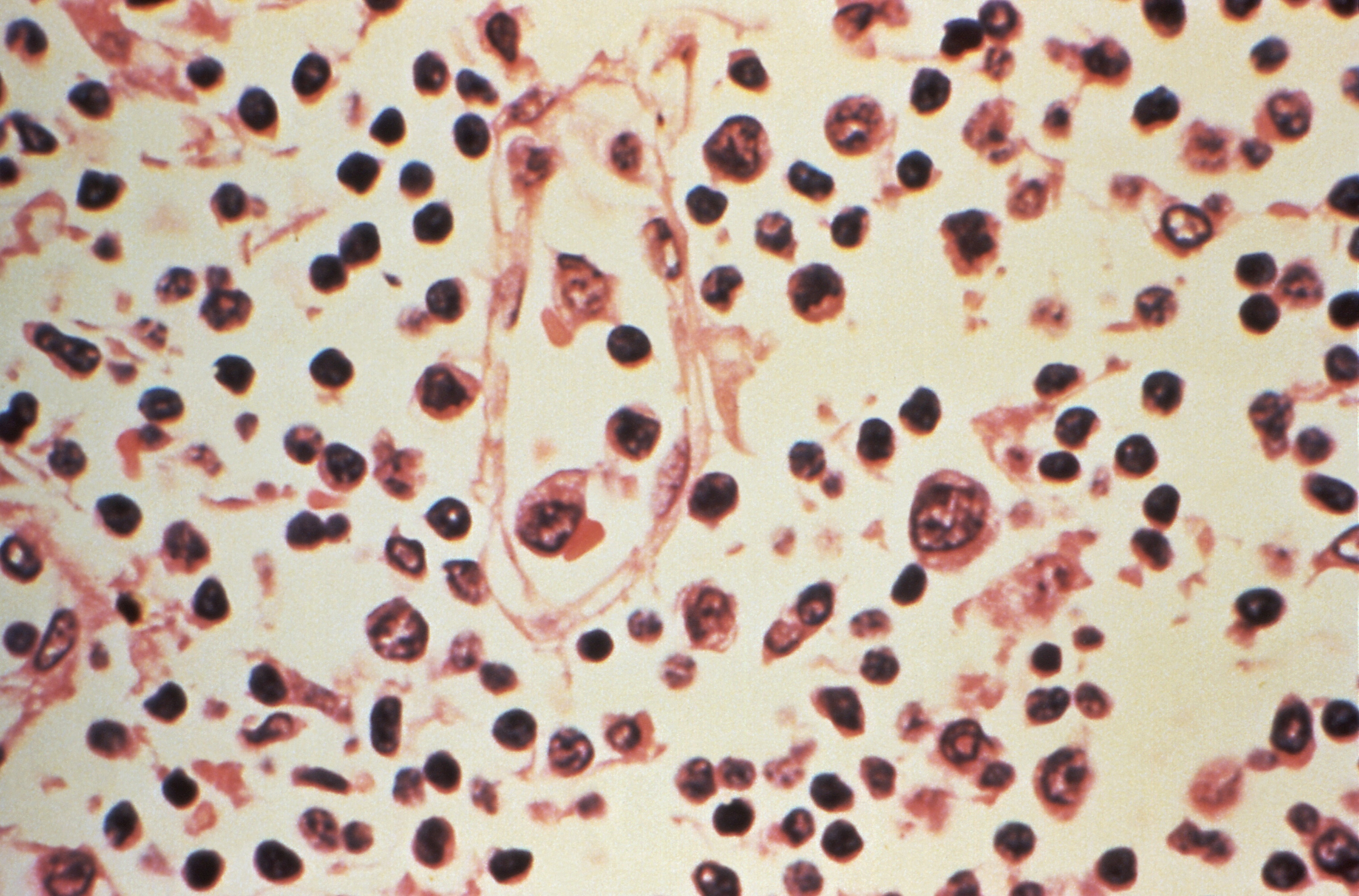 Lymph node specimen extracted from a patient suspected of a Hantavirus illness. (Photo: Reuters)