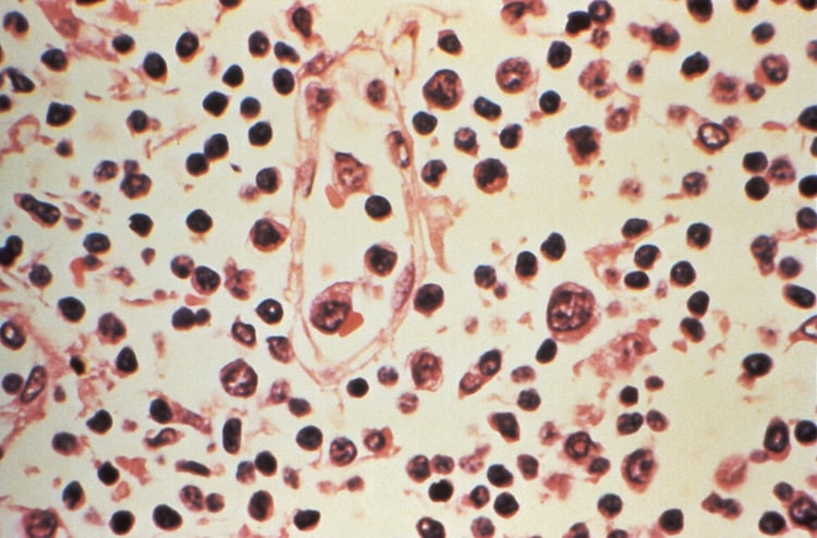 Lymph node specimen extracted from a patient suspected of a Hantavirus illness. (Photo: Reuters)