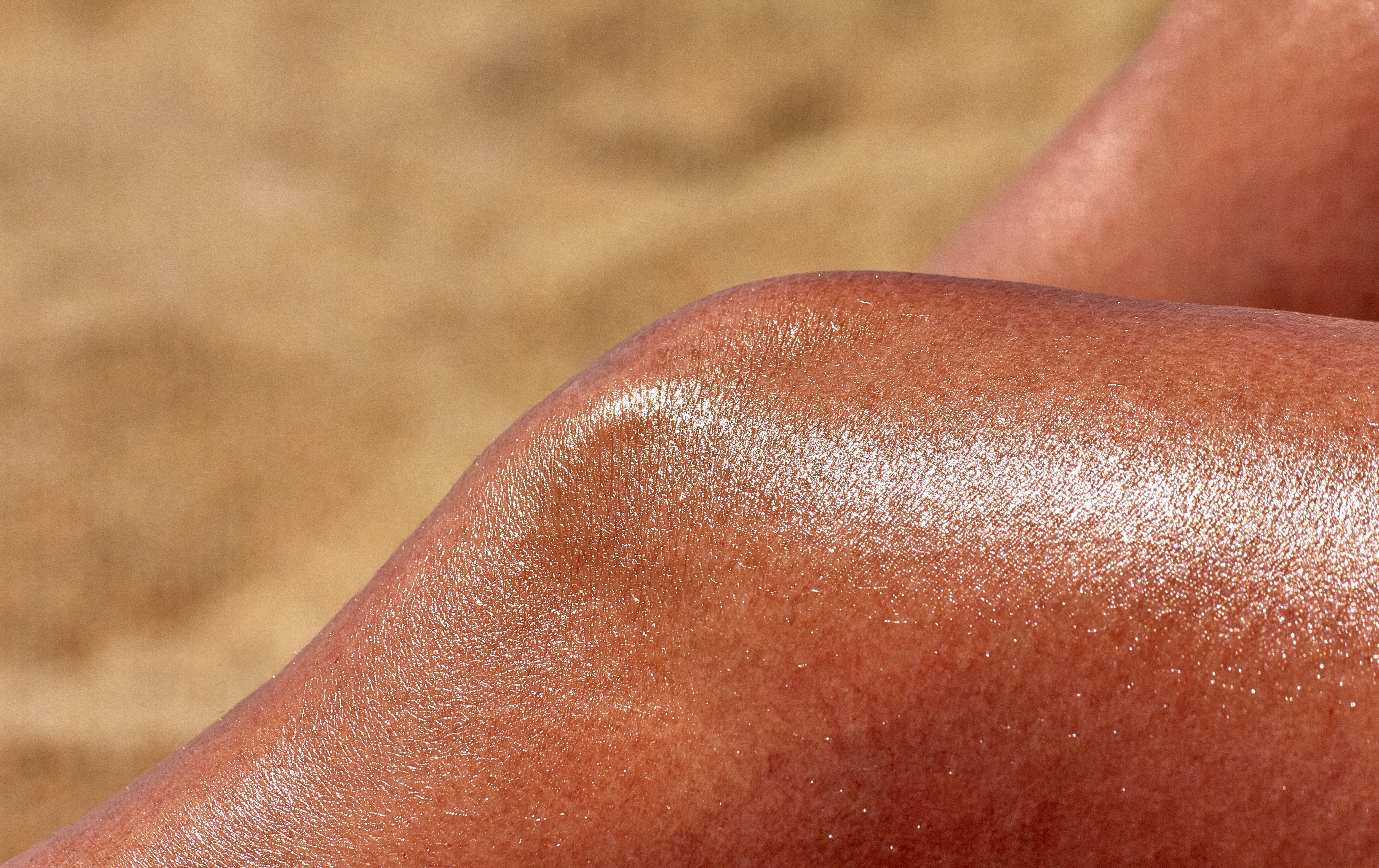 A close-up of sun-burned skin due to prolonged exposure to UV radiation. (Photo: Unsplash)