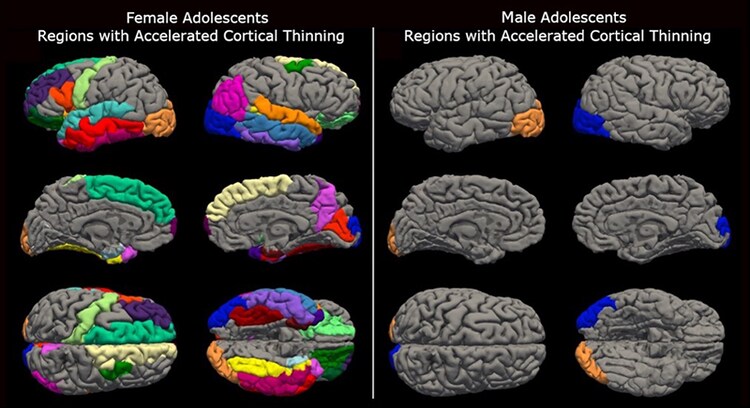 The greater effect on women's brains than men's may be due to differences in the importance of social interaction between girls and boys. (Photo: University of Washington)