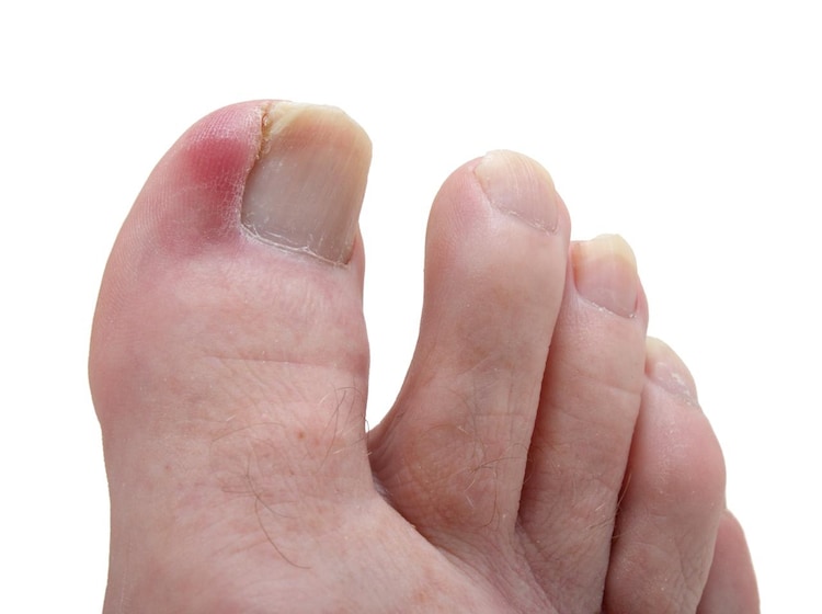 When it comes to ingrown toenails, don't ignore the signs