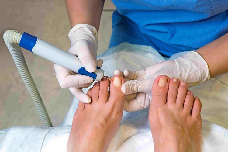 By maintaining proper nail hygiene, you can prevent ingrown nails