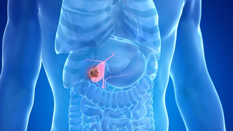 The gall bladder is a hard lump that is formed in the gallbladder, usually made of cholesterol or other substances. (Photo: Getty Image)