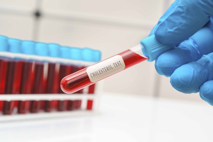 Cholesterol and blood sugar levels begin to fluctuate with age, diet and activity levels. (Photo: Getty Image)