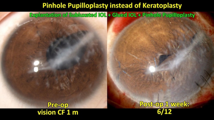 Ceratoplasty pinhole surgery