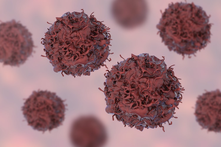 Among the large metropolitan cities, Delhi had the highest cancer rate in men, while Srinagar reported the most incidents of lung cancer. (Photo: Getty Image)
