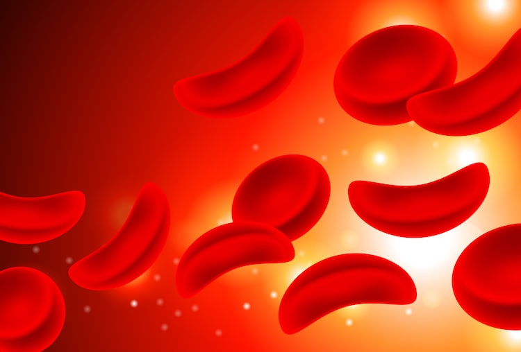 India's indigenous CRISPR therapy BIRSA 101 aims to offer a one-time cure for sickle cell disease at a fraction of the price charged abroad. (Photo: Getty)