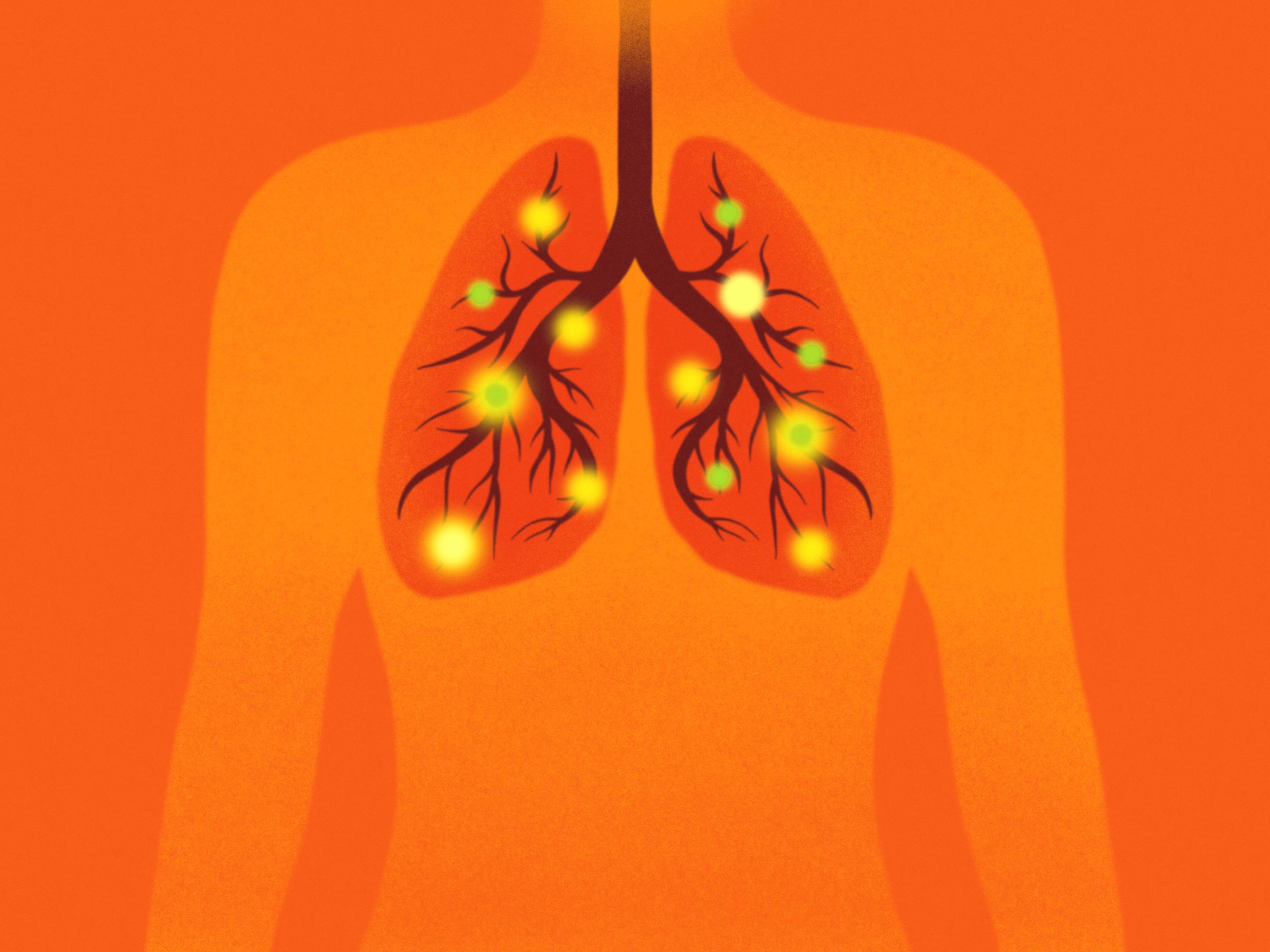 Mortality rates in severe pulmonary cases can reach nearly 38%, particularly once serious breathing difficulties begin. (Photo: Getty Images)